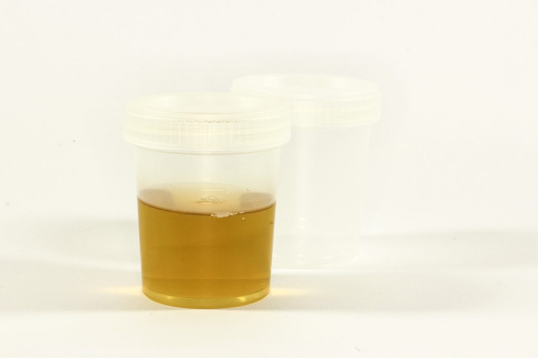 Emazie nelle urine: le cause, i trattamenti