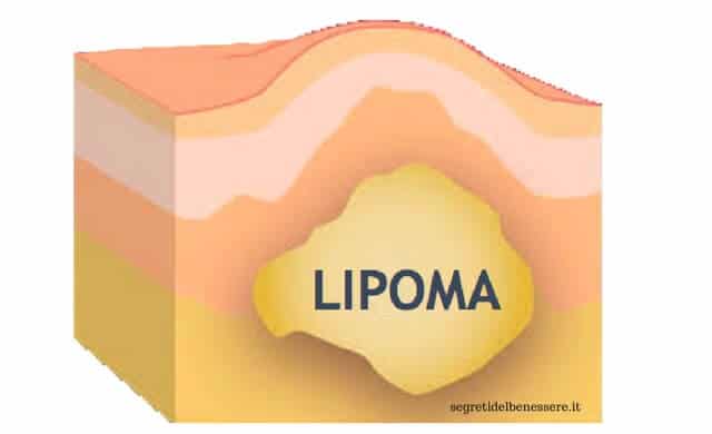 Lipoma: le cause, i sintomi, le cure