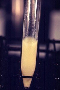 urina torbida - foto